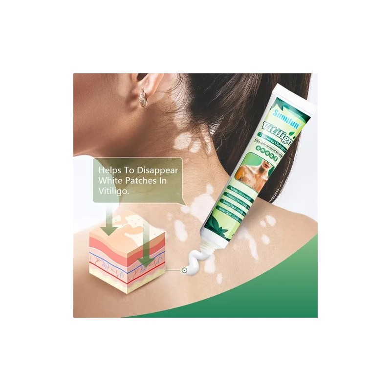 3 Cremas Vitiligo Tratamiento Profesional Sumifun