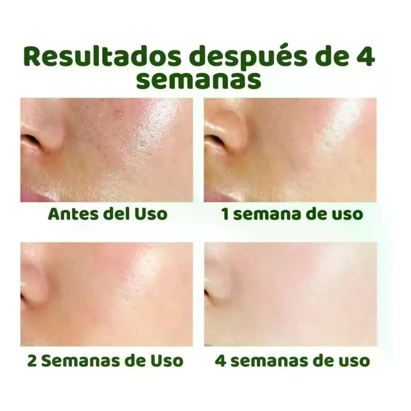 Sérum Facial Con Ácido Salicílico, Reduce Los Poros Y Contro