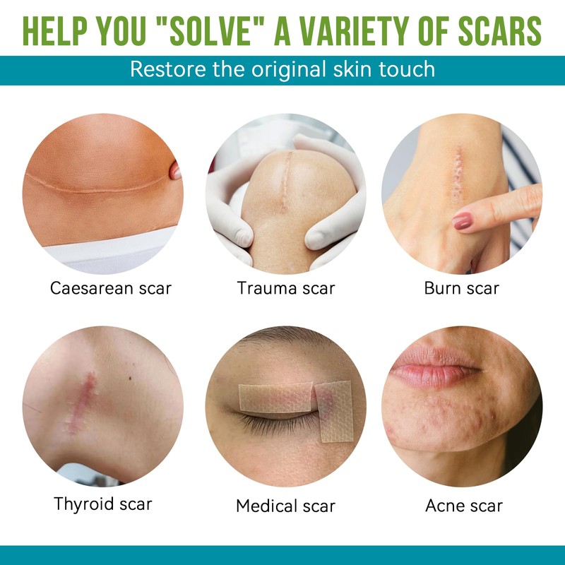 Silikonband für Narben, 300 cm, wiederverwendbar und waschbar, hautfarben