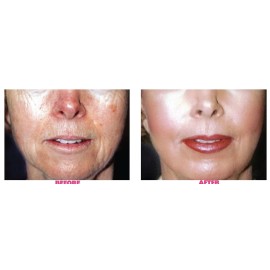 Planet Eden Glycolic Acid Skin Chemical Peel Kit with Skin Peel Neutralizer & Fan Brush - 40%