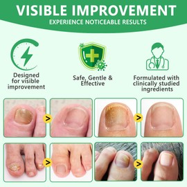 7days Ginger Nail Treatment, Natural Botanical Formula Nail Growth Oil, Intense Repair Of Damaged Nails And Nail Edges Supports a Healthier Nail Environment for Hands & Feet 60ml/2.02 Floz