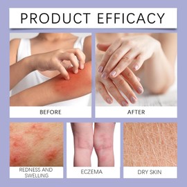 WUJECT Ocean's Miracle -Eczema Relief Cream，Eczema Healing Blend - Natural Soothing Skin Relief for Dry, Made with Organic Ingredients - 4 oz (1 pcs)