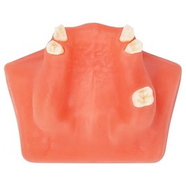 Ultrassist odontológico de elevación y colocación de implantes modelo B, modelo básico de entrenamiento de implantes con práctica de encías suaves, gran diente de entrenamiento dental para la práctica de implantes dentales