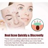 200pzs Mascarillas Estrella Acne