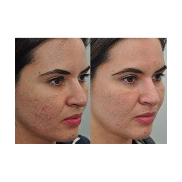 DCI SOLUCION ANTIACNE