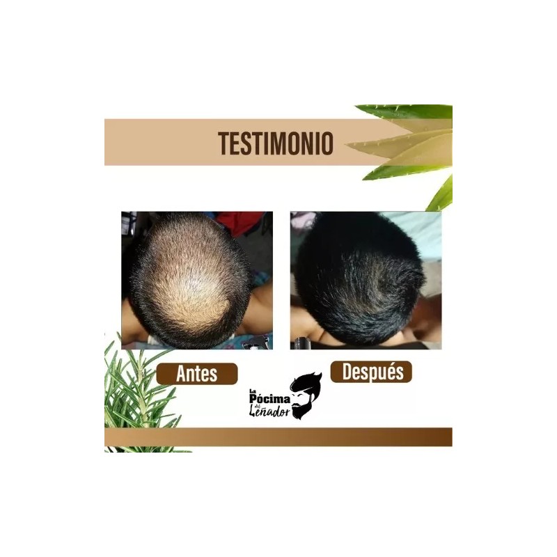 pócima de Rapunzel Kit Rapunzel Pócima Del Leñador, Anticaída Y