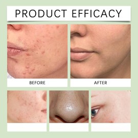 Acid Face Cream,10% Acid Gel For Facial and Skin Care,Ac/id 10% Acne Tratment Ge/l,Anti Acne G/el for Spot Prone Sk/in,Brightening Face S/kin Care Treatment,Dark Spot Serum Cream for Face