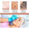 Herramienta Para Quitar Verrugas Condilomas Vph Zona Bikini