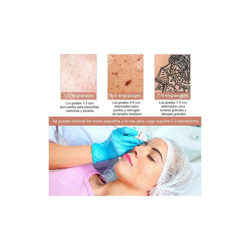 Herramienta Para Quitar Verrugas Condilomas Vph Zona Bikini