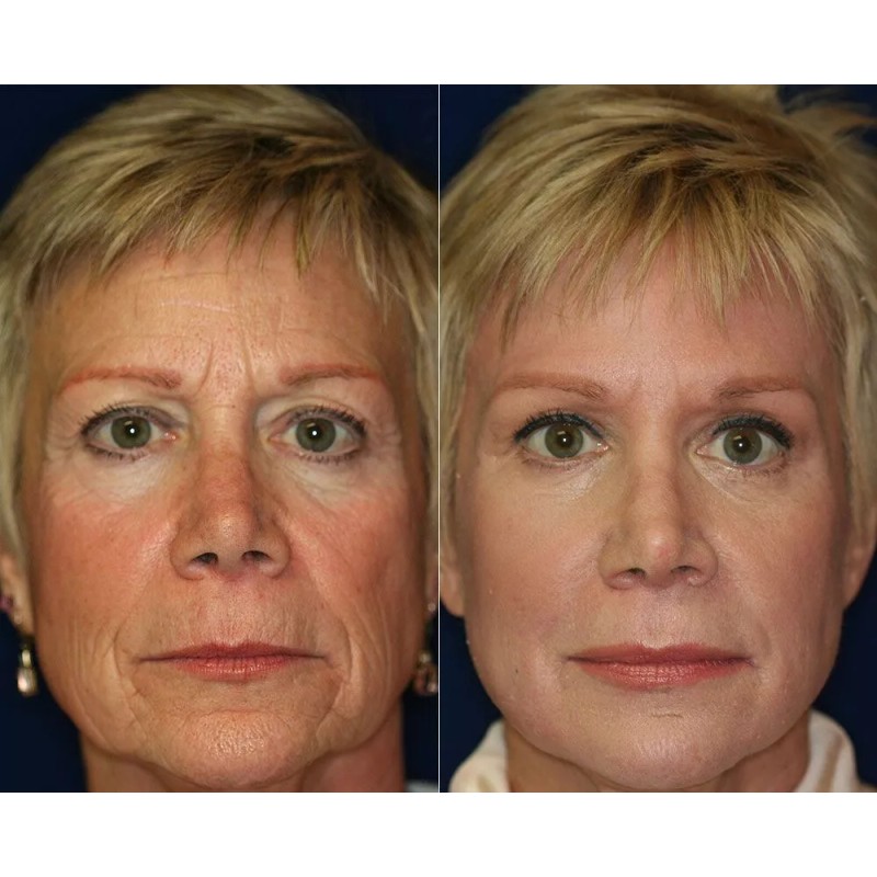 DERMA CLINICALS Retinol + Collagen, Hyaluronic Acid, Vitamin C AntiAging