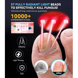 LOZLTX nagelpil lasegerät 【21-Tage schnell】【Präzise Timer: 3|5|7|10 Minuten】 für mehrere & FingernägelNagelpilz LaserGerät für ehandlung, 57pcs Blaues Licht und Rotes Licht Nagelpilz Laser （Gold）