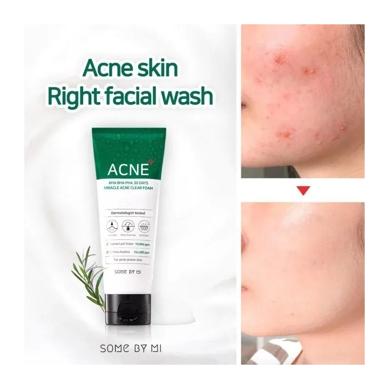 Espuma Limpiadora Some Miracle Acne Foam 100ml Antiacné Rostro