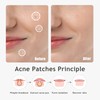 Dazzlook Ultra Pimple Patches, Zits and Blemishes Patch with Salicylic