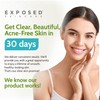 Exposed Skin Care Basic Acne Treatment Kit - Includes Salicylic