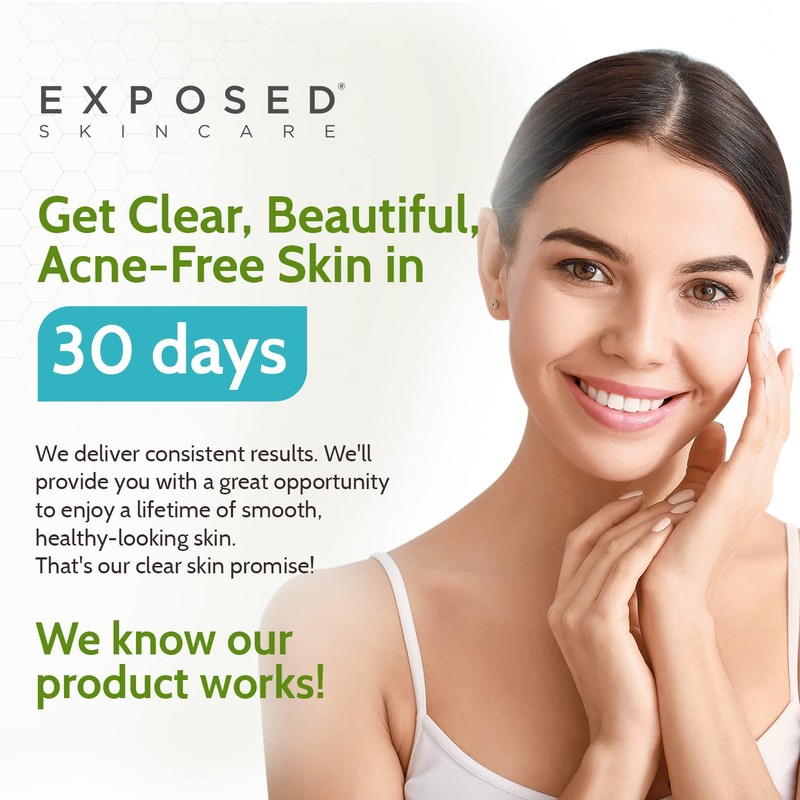 Exposed Skin Care Basic Acne Treatment Kit - Includes Salicylic