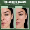 Sérum Antiacné Con Acido Salicílico Para Todo Tipo De Piel
