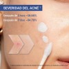 Leo Acne Buster Loción Secante Ácido Salicílico