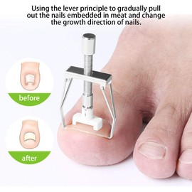 Ingrown Toenail Tool, Toenail Removal Clippers, Nail Treatment Ingrown Toenail Fixer Adjustable Toe Nail Paronychia Corrector Pedicure Care Tool Set