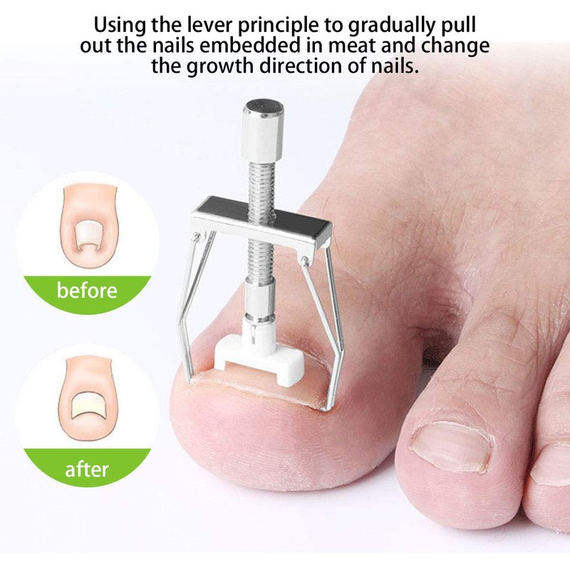 Ingrown Toenail Tool, Toenail Removal Clippers, Nail Treatment Ingrown Toenail