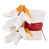 1:1.5 Human Herniated Disc Model Spine Anatomical Medical Study Demonstration