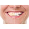 Blanqueador Dental Carbón Activado - 100% NATURAL - No OGM,