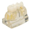 Teeth Implant Model Transparent Dental Teaching Research Demonstration Teeth Model