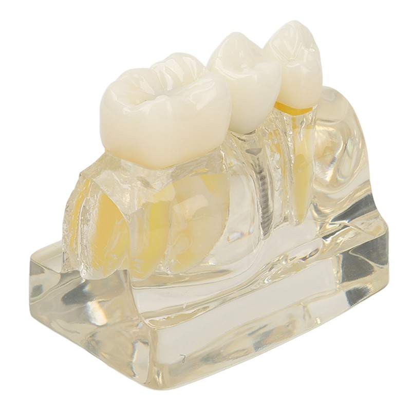Teeth Implant Model Transparent Dental Teaching Research Demonstration Teeth Model
