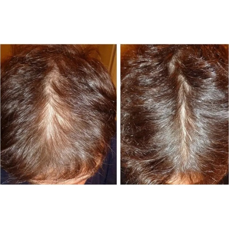 Sistema Novocrin Tratamiento Completo