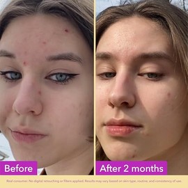 Good Molecules Niacinamide Serum 30ml - 10% Niamcinamide Balancing B3 Facial Serum for Acne, Enlarged Pores, Tone, Texture, Brightening, and Hydrating