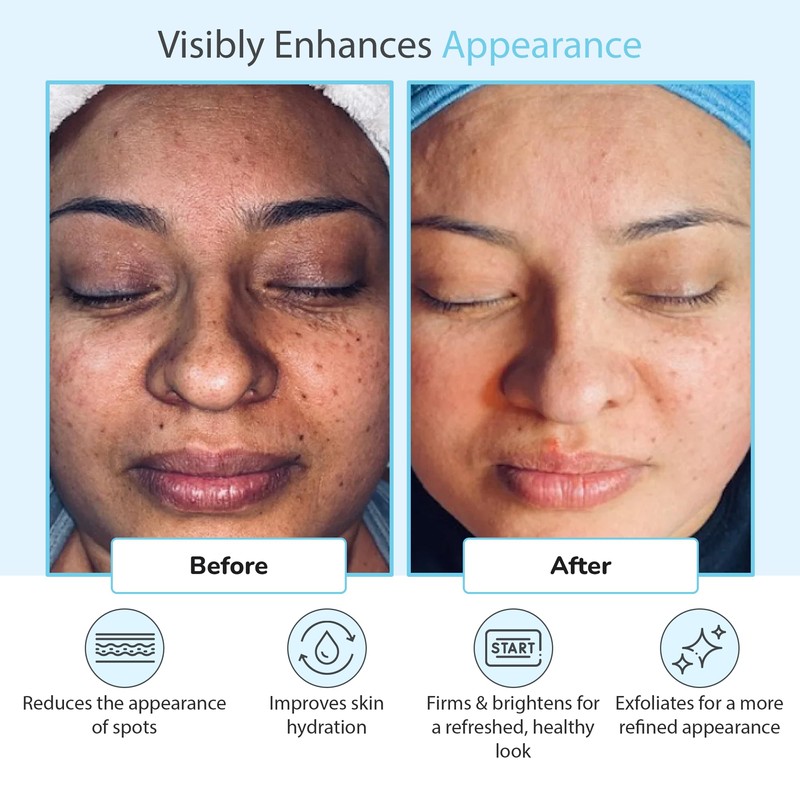 Glycolic Acid 50% Gel Peel - Enhanced with Retinol &