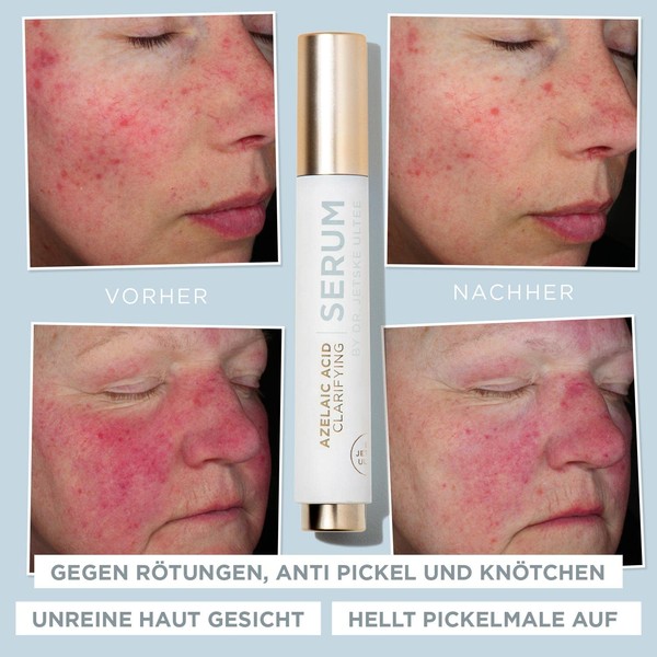 Azelaic Acid Serum (Azelaic Acid) Dr. Jetske Ultee | Against