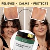 Thyme & Tea Tree Flare Care | Solution for Painful