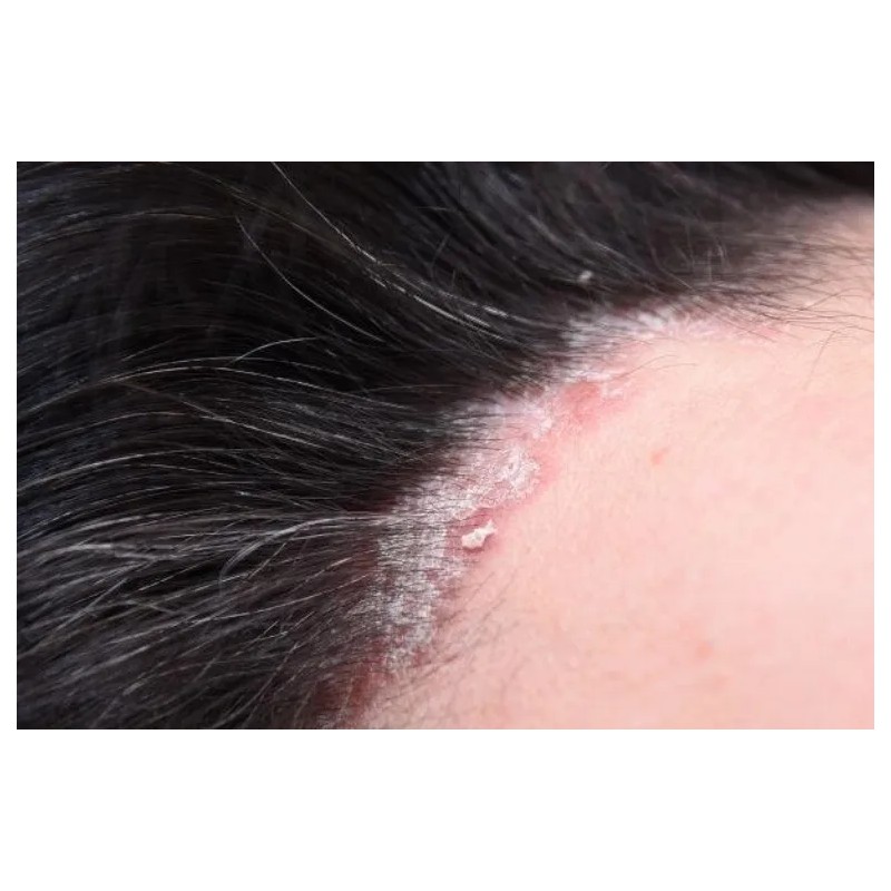 Shampoo Alquitrn D Hulla Control Psoriasis Caspa 1 Litro