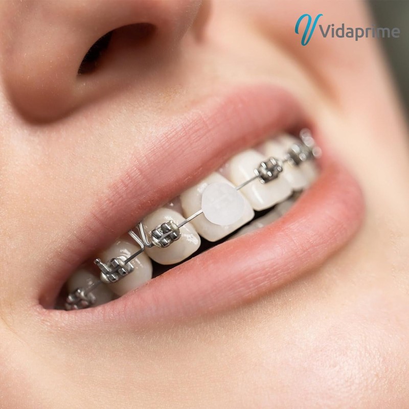 Vidaprime 10 Pieces Orthodontic Wax Tubes 350 Pieces Pre-Cut Teeth