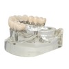 Ningfan Dental Implant Model,Implant All on 4 Overdenture Treatment Model,
