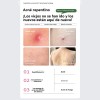 Acné De Marcas Acné De Eliminación De Esencia Jd