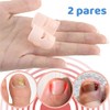 Set 2 Pares Protector Dedo Gordo Uñas Encarnadas Uñeros Alivia