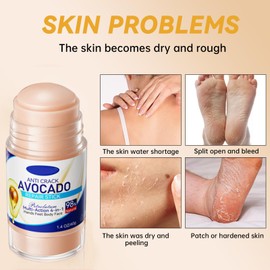 2flaschen Summer Foot Fusscreme Sehr Trockene FüSse FußCreme FüR Sehr Trockene FüßE Fusscreme Sehr Trockene FüSse Hornhaut Creme Fusspflege Creme FußPflege Crem FußCrem Gegen Hornhaut,Mit 10 FußMasken