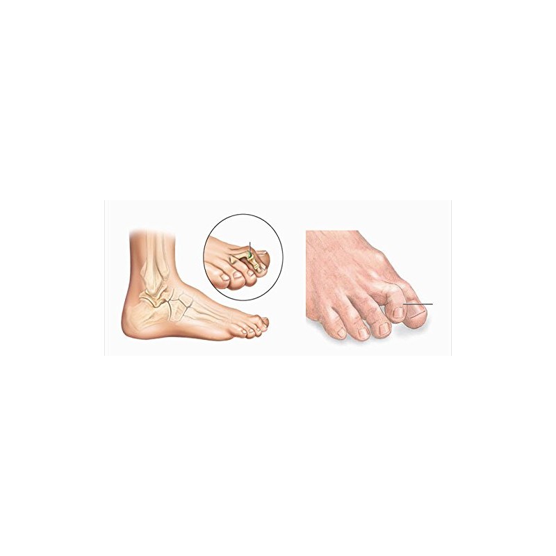 Hammer Toe Correctors