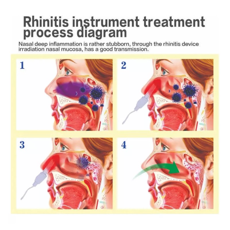 Beurha Laser Terapia Rinitis Alergias Adulto/niño Envio Gratis