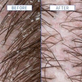 AAVRANI Scalp Rescue Serum - Salicylic Acid Treatment For Dandruff, Itchiness, & Scalp Build Up - With Oatmeal & Neem to Soothe - Vegan - 2 Fl Oz | AAVRANI