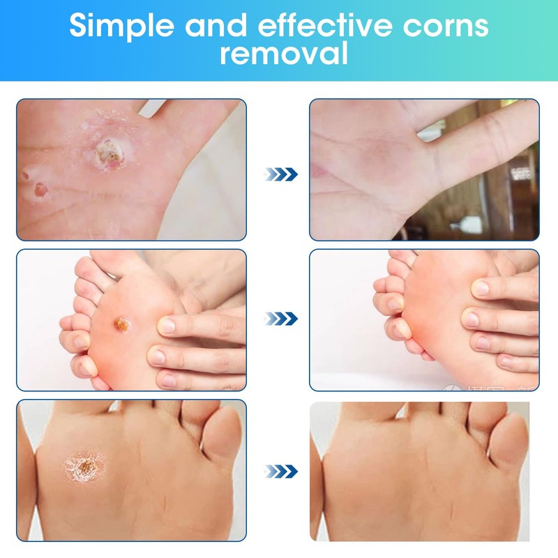 Corn Removal Pads 38