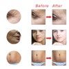 Micro Needle Titanium Derma Roller 0.5 for Face Body Skin