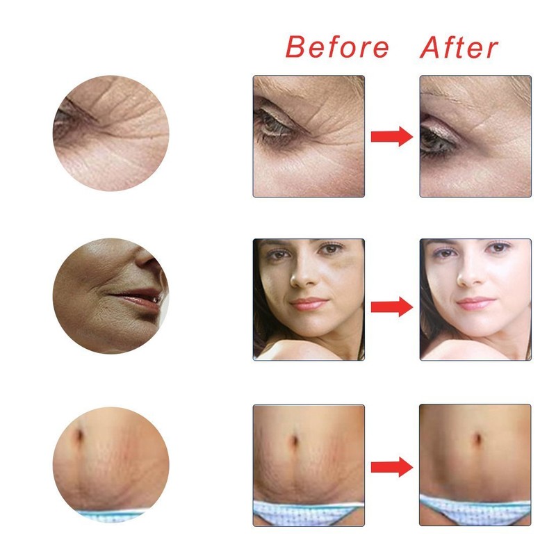 Micro Needle Titanium Derma Roller 0.5 for Face Body Skin