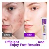 Tratamiento Facial Azelaico Al 12% Para Enrojecimiento, Oscu
