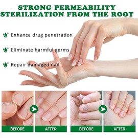 Ginger Nail, Tratamiento de Uñas con Jengibre, Soporte para Uñas | Cuidado de Uñas, Suero para El Crecimiento de Uñas con Jengibre, Aceite Fortalecedo