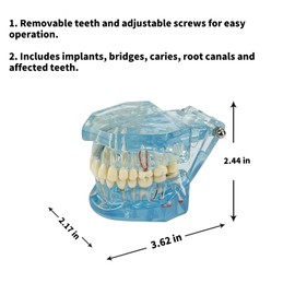 SENLIN DENTAL Transparent Disease Teeth Model with Dental Implant Bridge, Compact and Convenient Dental Models for Patient and Dental Student Education (Blue)