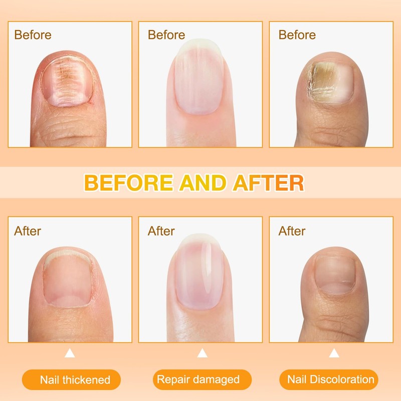 Bee Venom Nail Soothing Spray, Toe Nail Treatments for Damaged