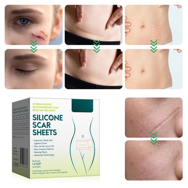 3 Meters Silicone Scar Stickers to Reduce Itching and Redness