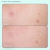 Skinfix Acne+ 2% Bha Tratamiento De Manchas Para El Acné: